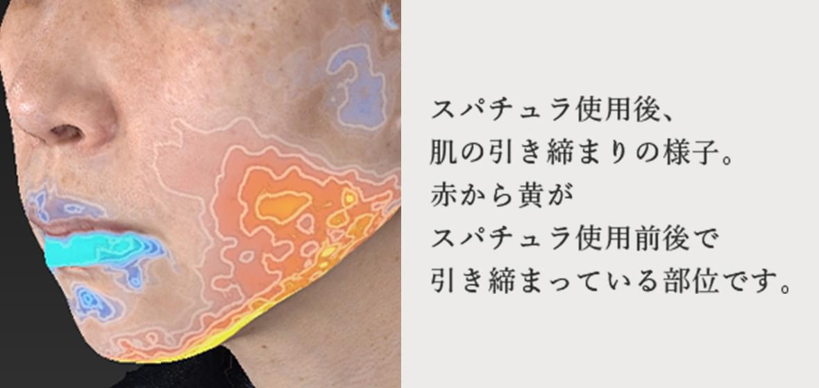 スパチュラ使用後、肌の引き締まりの様子。赤から黄がスパチュラ使用前後で引き締まっている部位です。